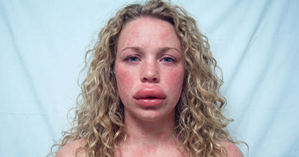 Infographic showing common anaphylaxis warning signs.
